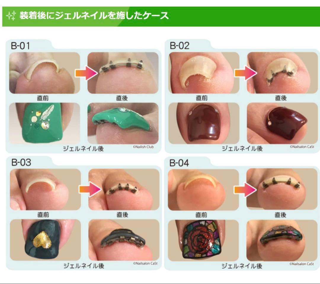 まき爪リフト　4個セット【正規品】